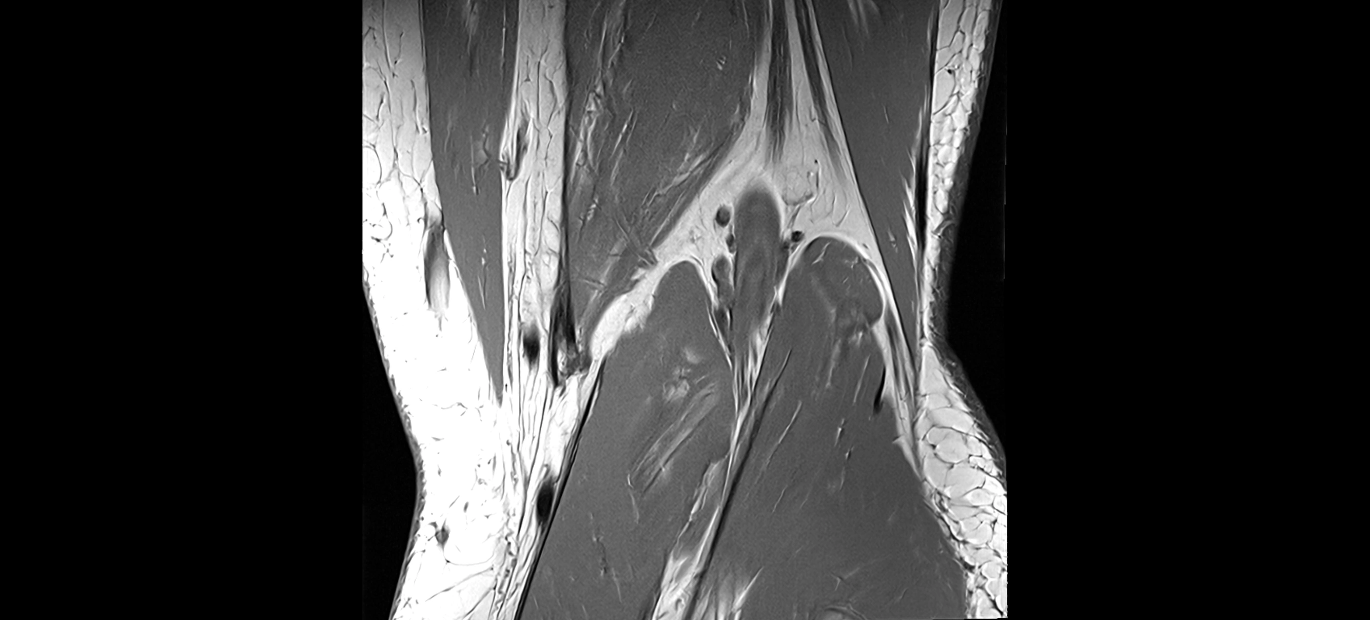 MRI coronal  ligaments cross sectional anatomy 3T  radiology  image-img-04001-00035.webp